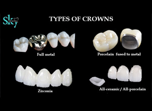 Dental Crowns and Bridges