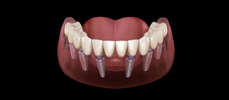 All on 6 Dental Implant